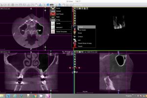 sinus volume assessment x mind