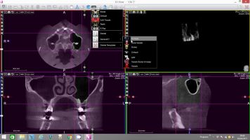 sinus volume assessment x mind