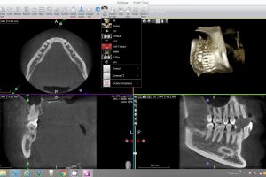 virtual endoscope mandibular nerve