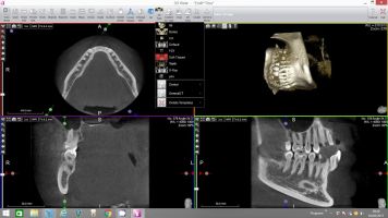 virtual endoscope mandibular nerve