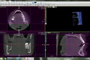 volume measurement in acteon