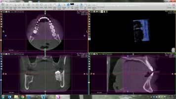 volume measurement in acteon