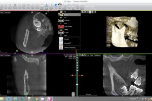 x mind trium 3rd molar virtual