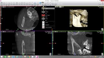 x mind trium 3rd molar virtual