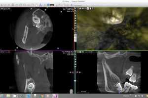 x mind trium endodontic virtual