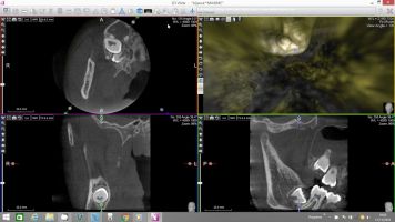 x mind trium endodontic virtual