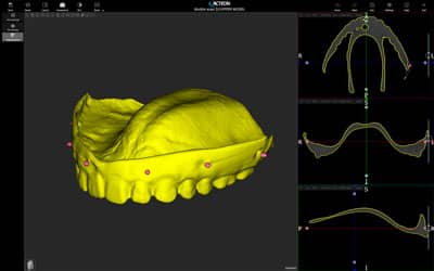 voxel dental x mind prime implant thumb