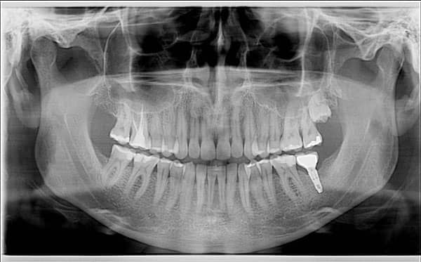 voxel dental x mind prime with ceph pano