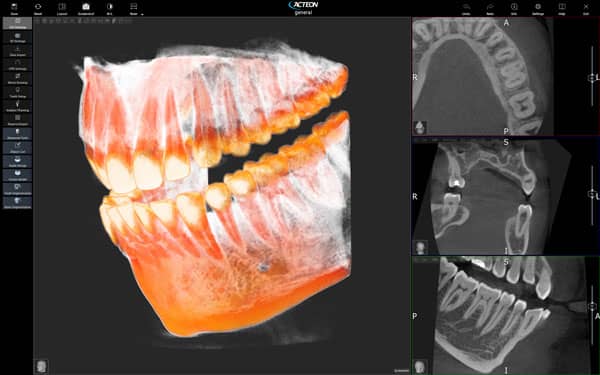 voxel dental x mind trium 3d