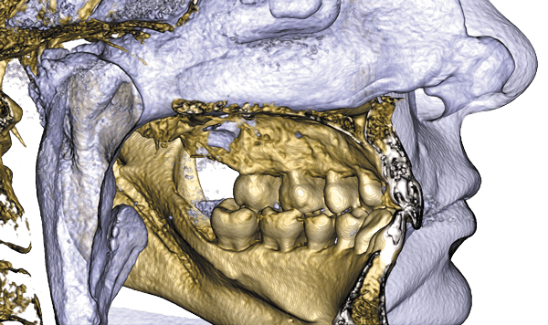 voxel dental x mind trium 75 micrometer quality