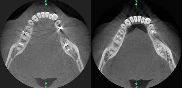 voxel dental x mind trium artifact reduction