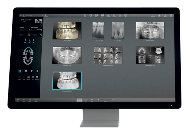 voxel dental x mind trium implant report